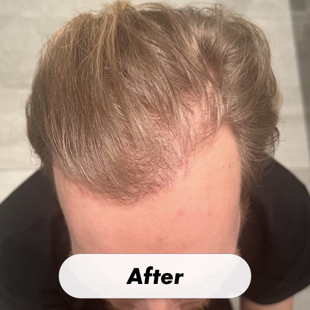 RedRegen Laser Hair Growth Cap™ - The Future of Hair Growth