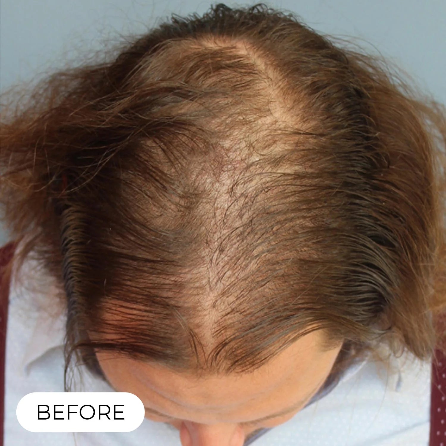 RedRegen Laser Hair Growth Cap™ - The Future of Hair Growth