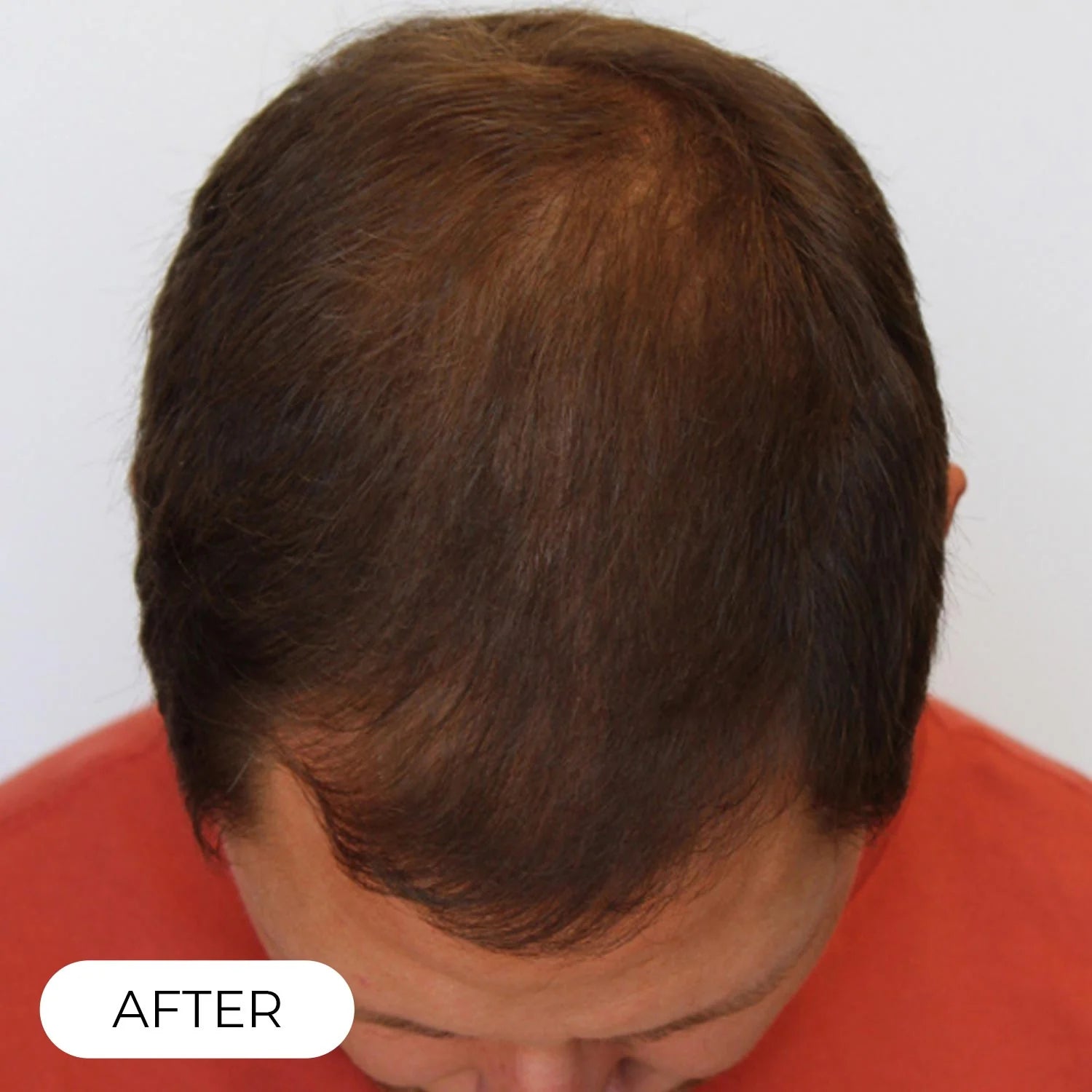 RedRegen Laser Hair Growth Cap™ - The Future of Hair Growth